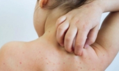 Một ca rubella vừa phát hiện: Bố mẹ chủ quan, trẻ lãnh hậu quả