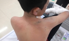 Đốt pháo ở nhà, một bé trai ở Ninh Bình bị bỏng nặng