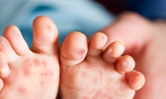 Phát hiện 3 ổ dịch tay chân miệng tại các trường mầm non tại Hà Nội