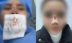 Hà Nội: Làm đẹp gần nhà, cô gái 25 tuổi thủng mũi, mưng mủ nhiễm trùng