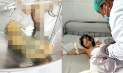 Bé gái 4 tuổi ở Cần Thơ mắc hội chứng
