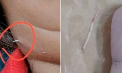 Đau cổ dữ dội, người phụ nữ bàng hoàng phát hiện vật lạ nhô ra từ cổ mình