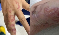 Sau khi ăn gỏi cá mè sống vài ngày, kinh hoàng phát hiện sinh vật 