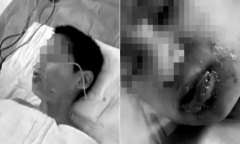 Xót xa: Một nam sinh bị 2 bạn cùng lớp dội nước sôi vào miệng bắt uống