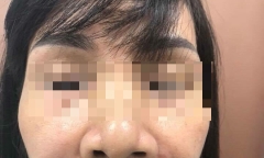Cô suýt hoại tử mặt vì “ủng hộ spa” của cháu gái: Lời cảnh tỉnh về chất làm đầy filler