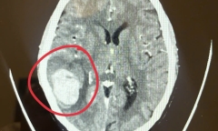Người phụ nữ thoát đột quỵ nhờ sáng suốt “đi viện ngay khi thấy mặt méo”