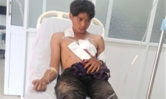 Nổ mìn tự chế khi đi đánh cá, 2 người bị đa chấn thương