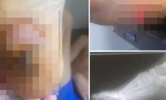 Bé trai 13 tuổi có nguy cơ mất chân vì nghịch thuốc lá điện tử
