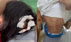 Vụ bé gái lớp 5 nghi bị bạo hành, vết thương khắp cơ thể: Công an vào cuộc
