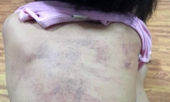 Cháu bé 5 tuổi bầm tím lưng ở Hải Phòng: Bị bạn đấm 20 lần vào vùng lưng, gáy