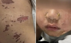 Bé trai bỏng nhẹ ở miệng, 3 ngày sau lở loét toàn thân, nguyên nhân ít ai ngờ