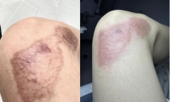 Ngọc Trinh điều trị những vết tích do tai nạn mô tô để lại
