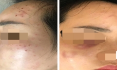 Đi tiêm meso, cô gái bị chủ spa tiêm nhầm sữa rửa mặt vào da
