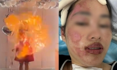 Clip: Bóng bay phát nổ khi thổi nến sinh nhật, cô gái Hà Nội bỏng nặng vùng mặt