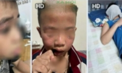  Lãnh đạo trường nói gì khi loạt học sinh dị ứng, sưng mắt ngay đầu tuần?