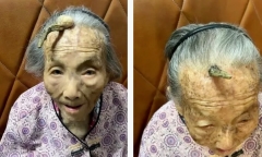 Sự thật “chiếc sừng trường thọ” dài 10cm trên trán cụ bà 107 tuổi