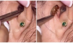Đi khám vì ngỡ ù tai, người phụ nữ bàng hoàng khi bác sĩ gắp ra 