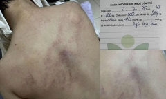 Vụ bé gái 4 tuổi bị giáo viên đánh đập, ném vào tường ở Hà Nội: Đang chờ kết luận giám định thương tích