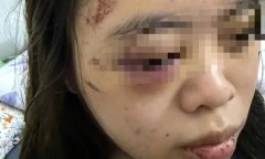 Vụ thiếu nữ 17 tuổi bị đánh 