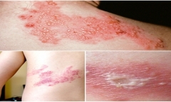 Virus thủy đậu tồn tại trong cơ thể người có thể gây ra bệnh zona