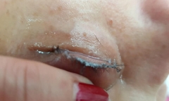Cô gái đau đớn loại bỏ 2 hàng lông mi vì lý do ai biết cũng rùng mình vì sợ hãi
