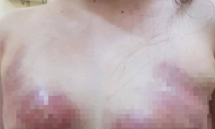 Tin tức đời sống mới nhất ngày 12/1/2019: Vòng 1 biến dạng sau 3 ngày bơm mỡ nhân tạo nâng ngực