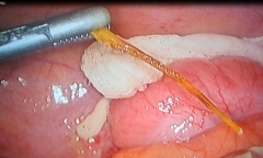 Ăn canh chua cá tai tượng bị xương dài 4 cm đâm thủng ruột non