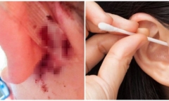 Tin tức đời sống mới nhất ngày 18/8/2019: Dùng tăm bông lấy ráy tai, người phụ nữ suýt tử vong
