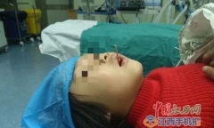 Cứu sống bé gái bị que xiên đâm xuyên cổ họng khi ăn xúc xích