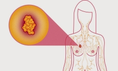 Những hiểu lầm nguy hiểm về căn bệnh ung thư vú