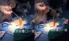 Bác sĩ phẫu thuật, gắp lươn ra khỏi bụng bệnh nhân gặp nạn vì tự sướng