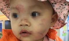 Tin tức đời sống mới nhất ngày 25/10/2019: Bé trai 14 tháng bầm tím cơ thể ngay ngày đầu đi học