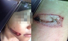 Vụ bé gái nghi bị cha ruột và mẹ kế bạo hành: Công an vào cuộc