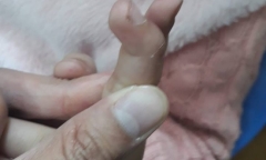 Hà Nội: Bé gái có ngón tay bị tật do mẹ tự chữa đứt tay ở nhà