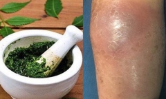 Đắp lá chữa gãy xương, người đàn ông suýt bị hoại tử chân vì biến chứng nặng