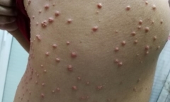 Những quý ông thích ăn nhậu cẩn thận bị mọc u lạ khắp người
