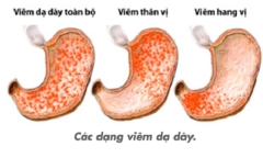 Bí quyết biến thanh niên chỉ nặng 45kg vì viêm dạ dày thành vóc dáng