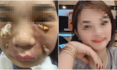 Bi hài hậu vận sau thẩm mỹ: 