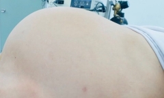 Phẫu thuật cắt thành công khối u buồng trứng 7kg cho nữ bệnh nhân 60 tuổi