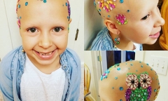 Bé gái 7 tuổi trọc đầu chỉ vì căn bệnh mà nhiều người vẫn coi thường