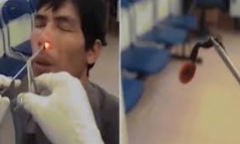 Video: Sởn da gà đỉa sống trong mũi người đàn ông ở Việt Nam