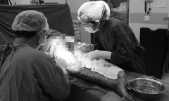 Cứu cô gái bị nhiễm liên cầu lợn qua vết xước trên tay