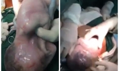 3 ca sinh con nằm trong bọc ối hy hữu tại Việt Nam khiến bác sĩ ngỡ ngàng
