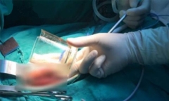 Bác sĩ kinh ngạc với chiếc cốc thủy tinh 