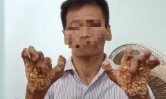 Bệnh “người cây” lần đầu được phát hiện ở Việt Nam