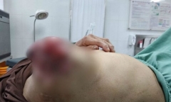 Người phụ nữ bị vỡ, loét khối u ngực vì tự ý đắp thuốc nam