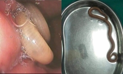 Tin tức đời sống mới nhất ngày 5/4/2019: Kinh hãi giun dài hơn gang tay trong dạ dày người