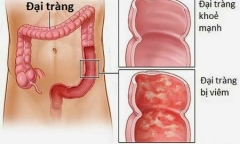 Chữa bệnh đại tràng bằng Đông y hiệu quả