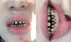 Rùng mình với hàm răng bị hư hỏng nặng của cô gái ở Hà Nội sau 2 năm bọc sứ