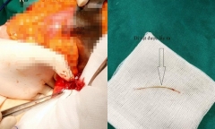 Ăn cá, cụ bà bị xương dài 4cm đâm thủng ruột